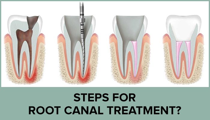 Root Canal Treatment (Endodontic Treatment)